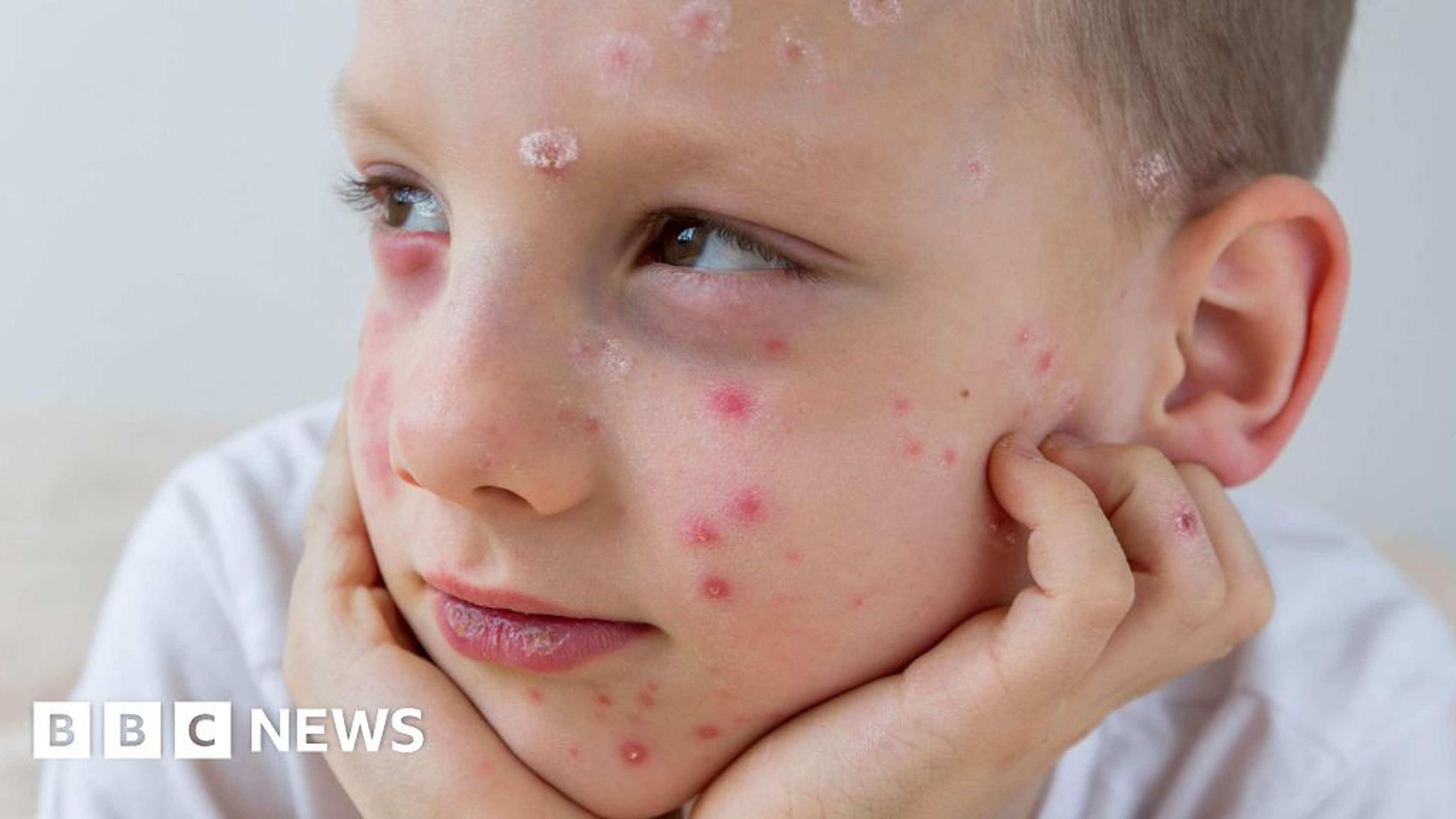 Global Health and Education Watch: What is chickenpox and who can get an NHS