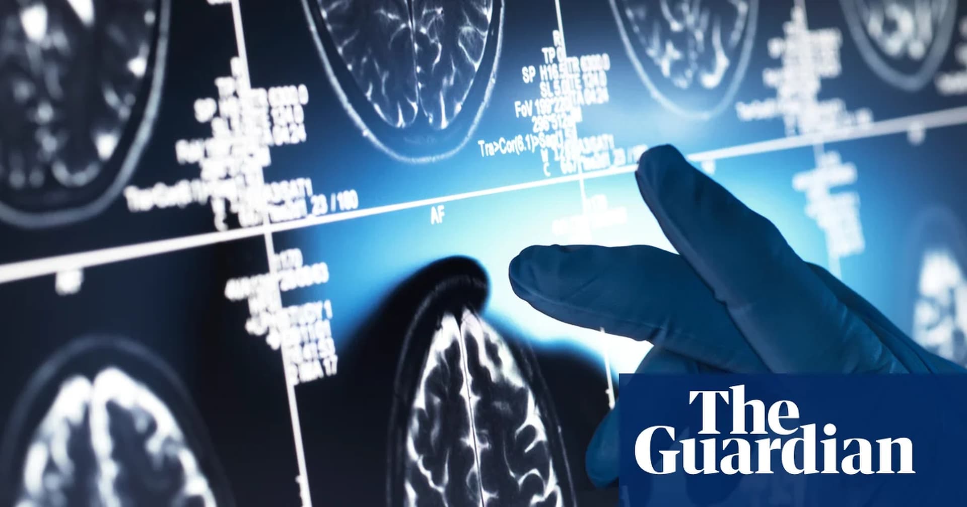 Alzheimer's 'Gamechanger' Drugs Show Trivial Impact, Global Review Concludes