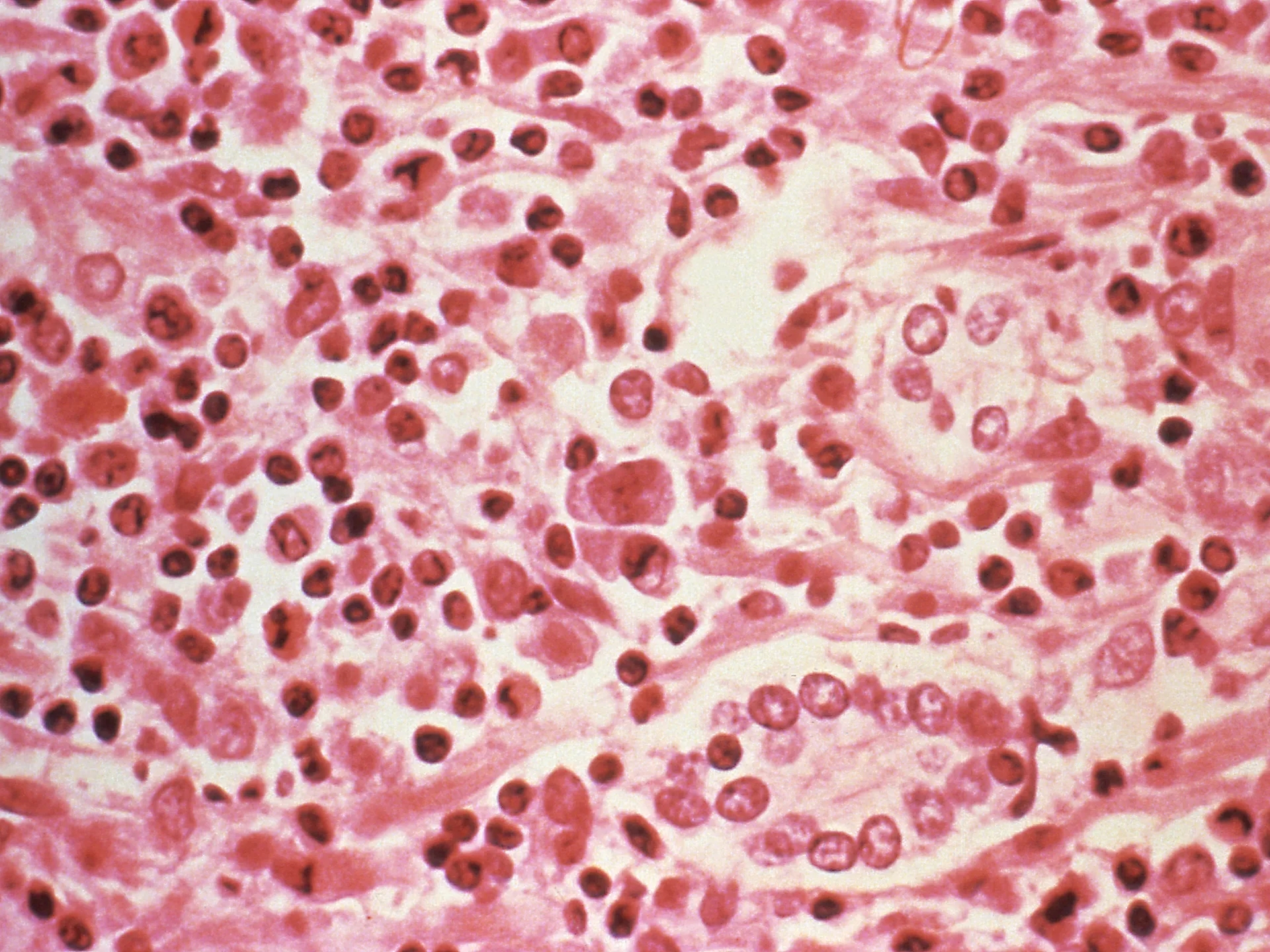 Suspected Hantavirus Outbreak Claims Three Lives on Atlantic Cruise