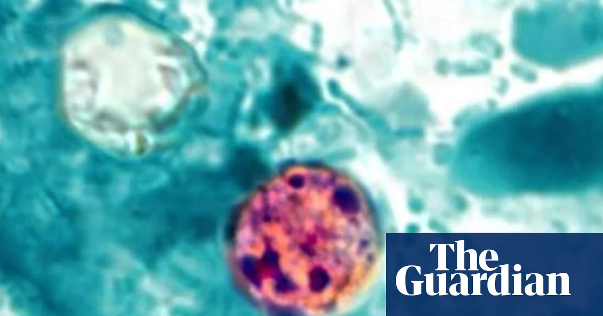 Global Health and Education Watch: What is cyclosporiasis, the parasitic illness causing ‘explosive’ diarrhea?