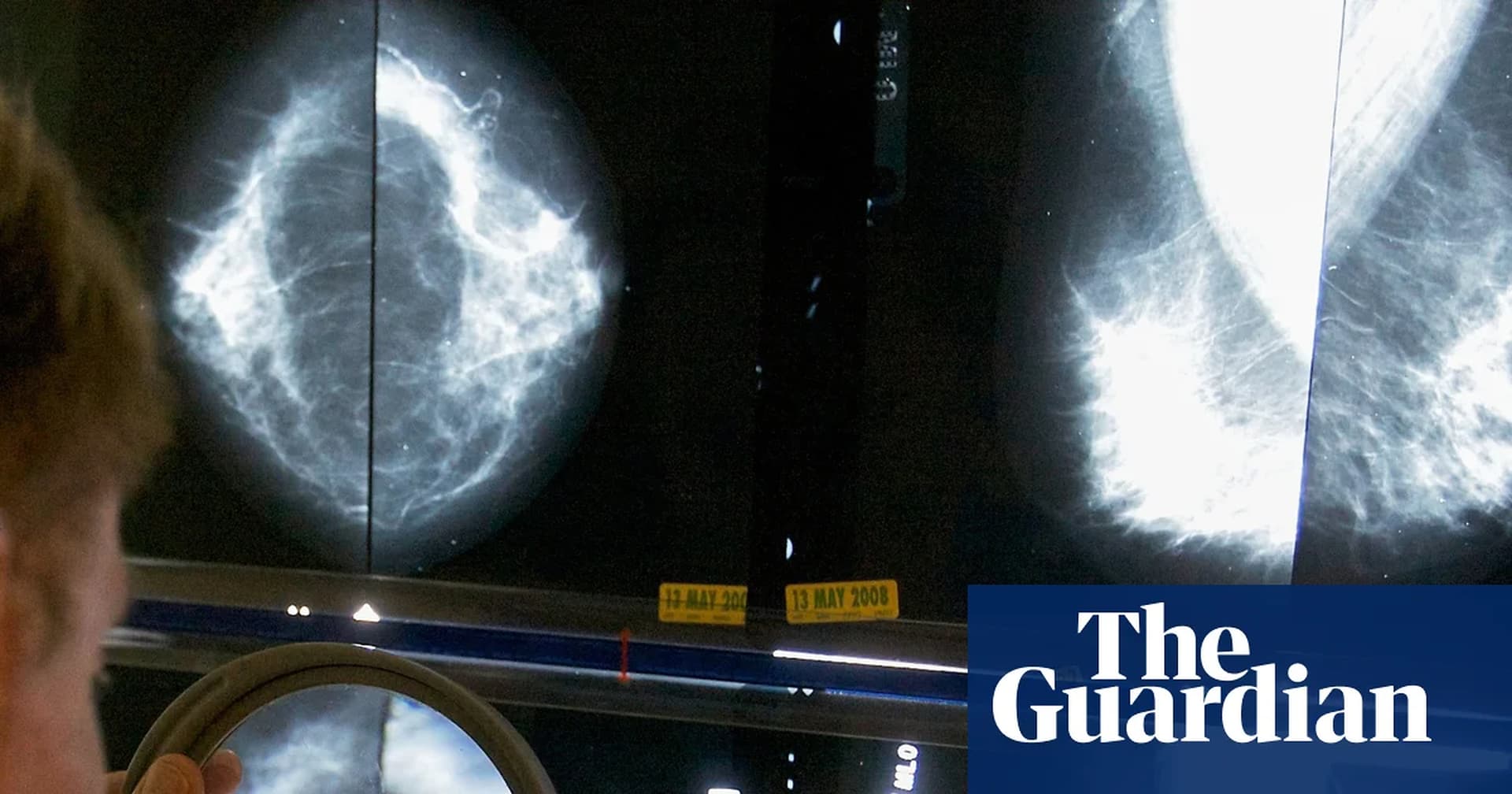 Global Health and Education Watch: GPs’ breast cancer guidelines ‘miss’ 95% of women who